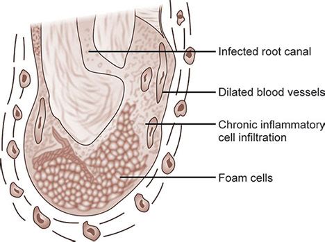 Periapical Granuloma Histology