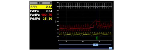 Fractional Flow Reserve (FFR) measurement of the right coronary artery ...