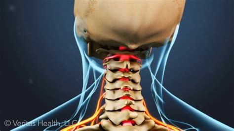 What Is Cervical Radiculopathy? | Radiculopathy, Cervical radiculopathy ...