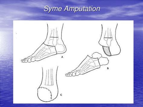 PPT - Basic Surgical Principles of Amputations and Disarticulations of the Upper and Lower ...