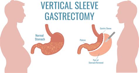 Gastric Bypass vs Gastric Sleeve: Compare Procedures