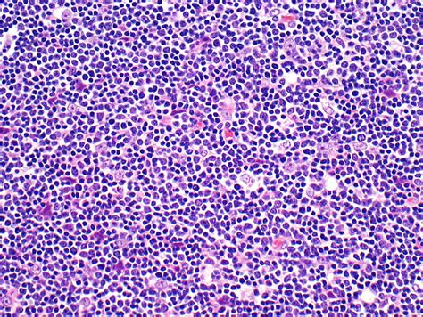 Pathology Outlines - Thymoma