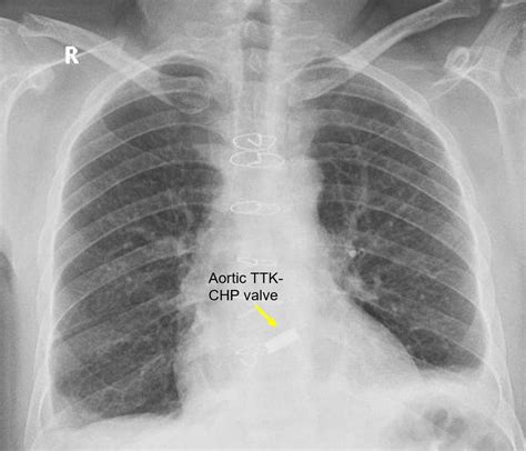 Mitral Valve Replacement X Ray