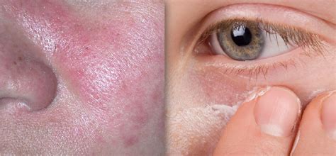 An Update on the Role of Topical Metronidazole in Rosacea