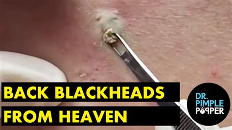 Back Blackheads from Heaven - Dr. Pimple Popper