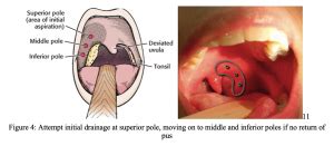 emDOCs.net – Emergency Medicine EducationUnlocking Common ED Procedures - Peritonsillar Abscess ...