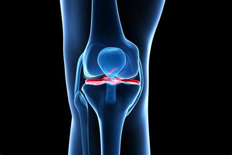 ACL Ligament Surgery in Delhi at Affordable Cost – Dr. Vikram Sharma