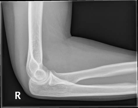 Elbow Joint Effusion Buyxraysonline | Free Nude Porn Photos