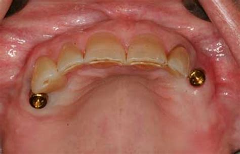 Claspless, removable partial dentures using implant-supported Locator attachments | DentistryIQ