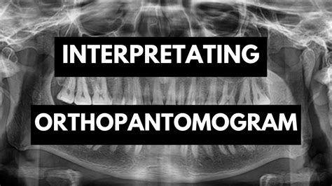 Interpretation of Orthopantomogram (OPG) In Detail - YouTube