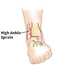 High Ankle Sprain | Symptoms, treatment, recovery, taping & surgery