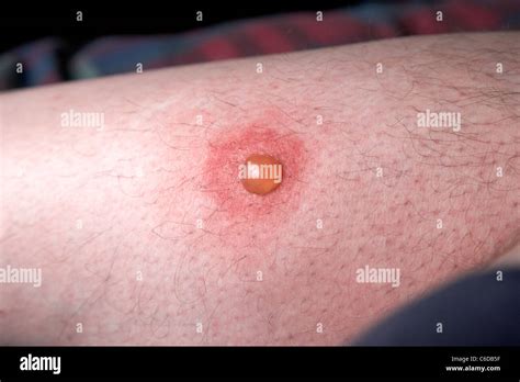 blister on a mans leg as a result of scratching a mosquito bite Stock Photo, Royalty Free Image ...