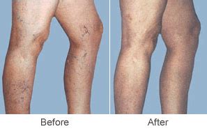 Varicose Vein Treatments & Sclerotherapy Treatment in St. Louis | Midwest Vein Care