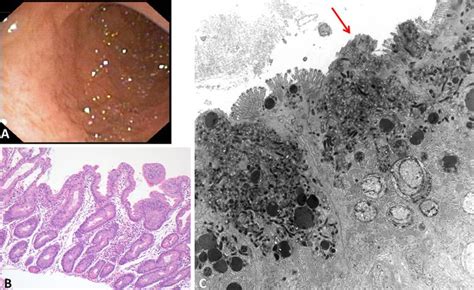 Microvillus inclusion disease, a diagnosis to consider when abnormal stools and neurological ...