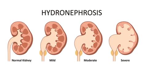 Hydronephrosis: Causes, Symptoms, Diagnosis, Treatment, & More - Healthroid