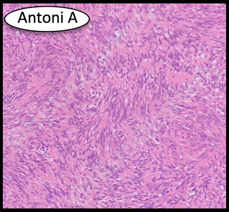 HistoQuarterly: SCHWANNOMA | Histology Blog