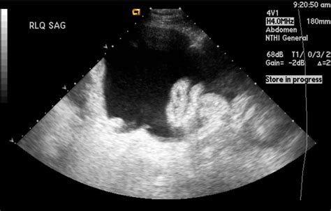 Paracentesis Procedure - Abdominal Paracentesis Position, Complications