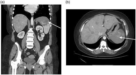 Characteristics and surgical outcomes of patients with atraumatic ...