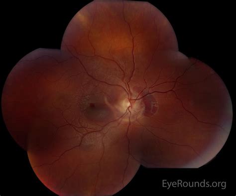 Choroidal rupture. EyeRounds.org: Online Ophthalmic Atlas