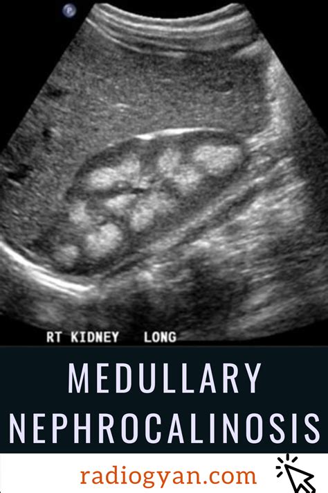 Medullary Nephrocalcinosis | Radiology Case | RadioGyan.com | Radiology, Medical ultrasound ...