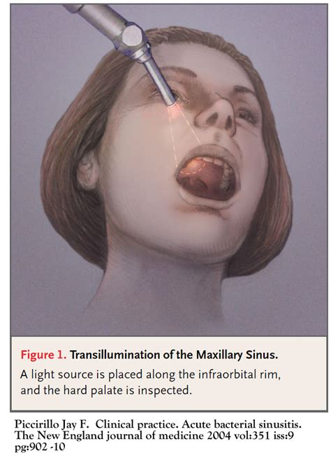 Maxillary And Ethmoid Sinus Disease