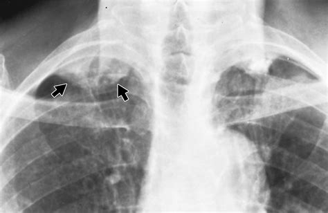 Solid Pleural Lesions | AJR