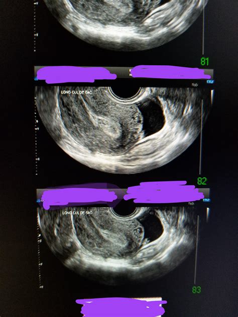 Ultrasound results- details in comments : r/DiagnoseMe