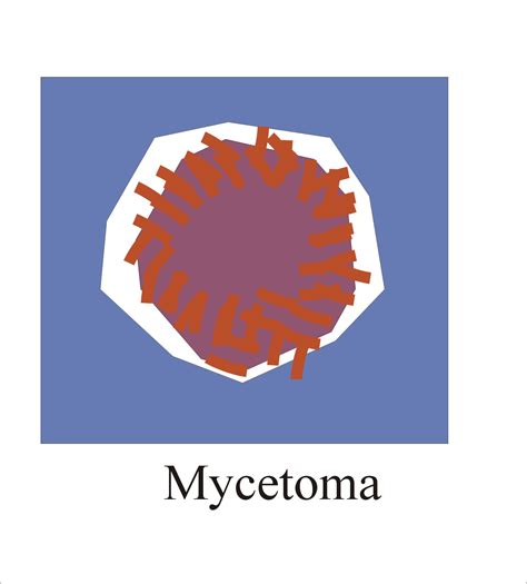 Mycetoma Diagnosis and Causative Agents - Labpedia.net