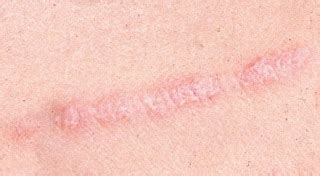 Skin Care Tips From Dermatologist: Koebner Phenomenon in Psoriasis