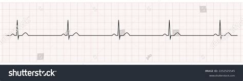 Ekg Showing Sinus Bradycardia Patient Stock Vector (Royalty Free ...