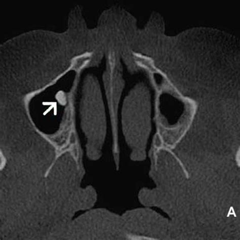 (PDF) Noninvasive aspergillosis as a maxillary antrolith: Report of a rare case