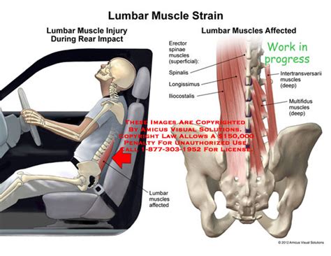 Lumbar Muscle Strain