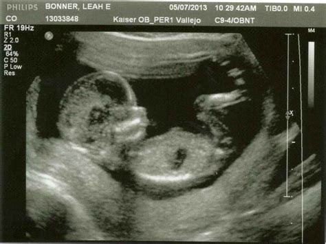 Short bus to minivan: Baby Girl, 20 Week Ultrasound