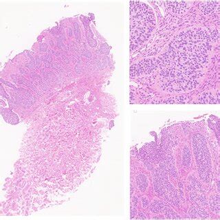 Skin punch biopsy (HE 2×) from the left chest demonstrating variably... | Download Scientific ...