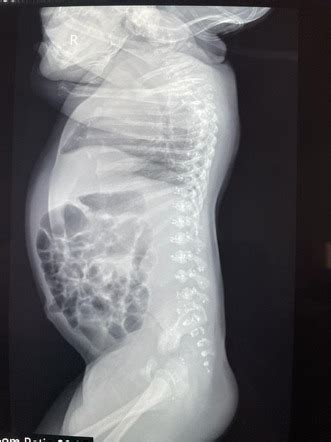 Brachytelephalangic chondrodysplasia punctata | Image | Radiopaedia.org