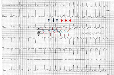 ECG Rhythms: Junctional Tachycardia: True or False