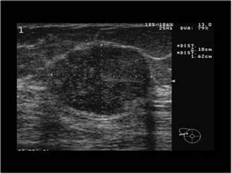 MEDICAL ULTRASOUND/ FIBROADENOMA BREAST