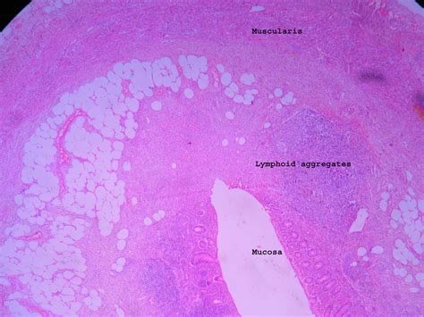 Acute Appendicitis – Histopathology.guru