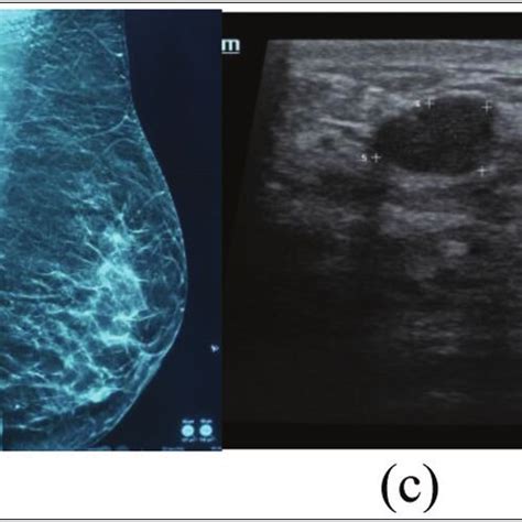 (A, B) X-ray mammography showing scattered areas of fibroglandular... | Download Scientific Diagram