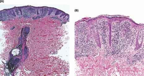 Necrotic Keratinocytes - Dermatopathology - Mussen Healthcare