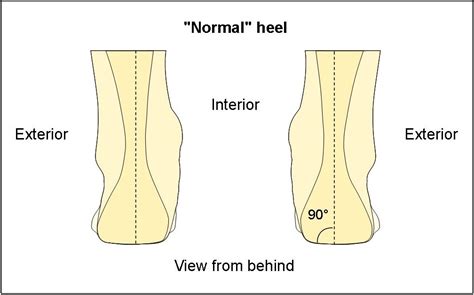 Pathologies > Calcaneal Valgus