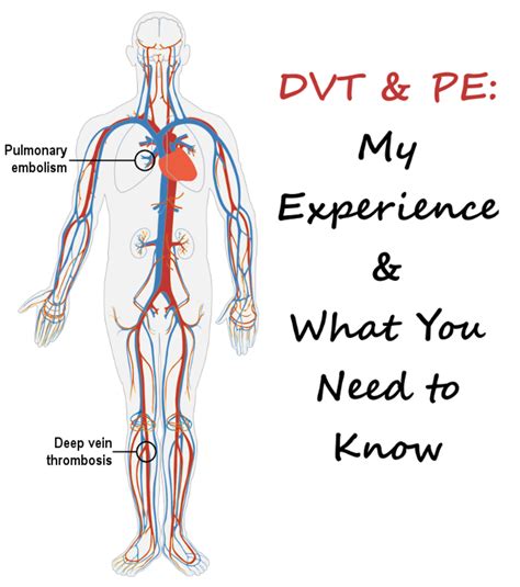 DVT and PE: Causes, Symptoms, Treatment, and Prophylaxis | Patient's Lounge