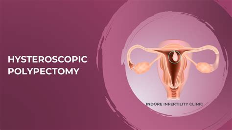 Removal of Uterine Polyp | Hysteroscopic Polypectomy (How is it done ...