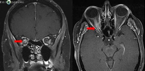 Optociliary Shunt Vessels — Ophthalmology Review