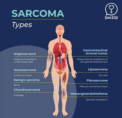 Understanding sarcoma, a form of bone cancer | FMT