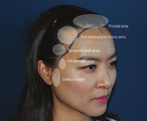 Five areas contributing to the frame of the female hairline. | Download ...