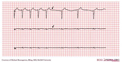 Av Block Ekg