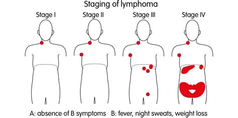 Childhood Hodgkin Lymphoma Disease – Stages and Prognosis