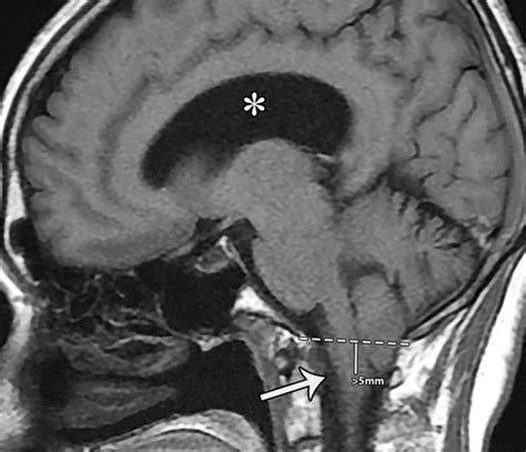 Cerebellar Tonsils Mri