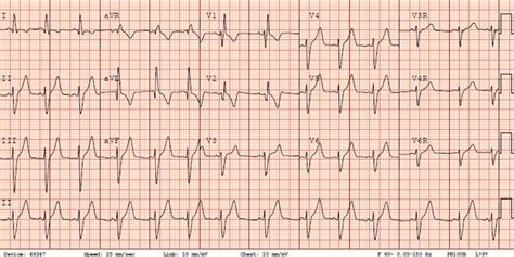 Myocardial Injury Ecg